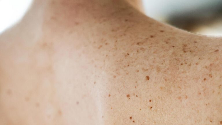 rücken muttermale dermascan360